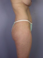 Liposuction Before and after photo