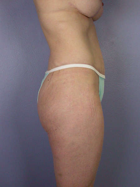 Liposuction before and after photo