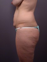 Liposuction Before and after photo