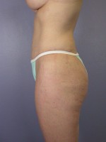 Liposuction Before and after photo