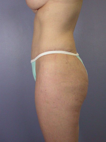 Liposuction before and after photo