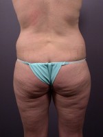 Liposuction Before and after photo