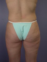 Liposuction Before and after photo