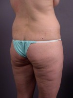 Liposuction Before and after photo