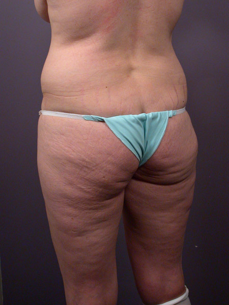 Liposuction before and after photo