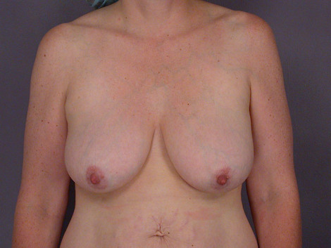 Liposuction before and after photo