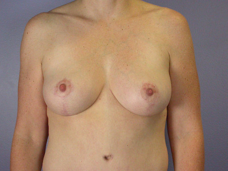 Liposuction before and after photo