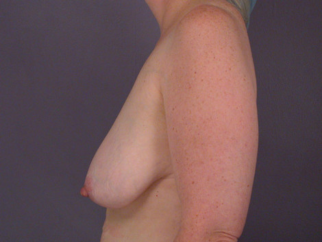 Liposuction before and after photo