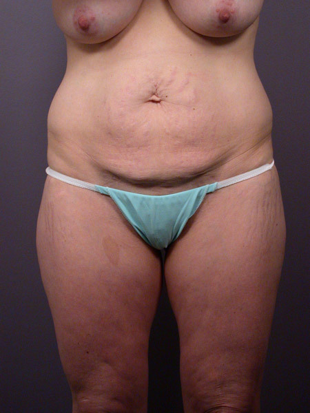 Liposuction before and after photo