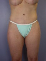 Liposuction Before and after photo