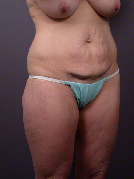 Liposuction before and after photo