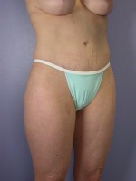 Liposuction Before and after photo