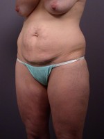 Liposuction Before and after photo