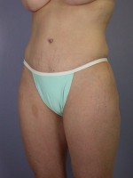 Liposuction Before and after photo