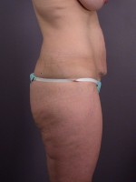 Liposuction Before and after photo