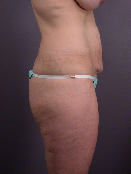 Liposuction before and after photo