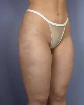 Liposuction before and after photo