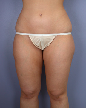 Liposuction before and after photo
