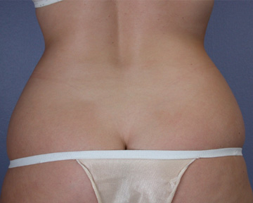 Liposuction before and after photo