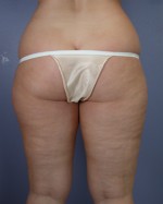Liposuction Before and after photo