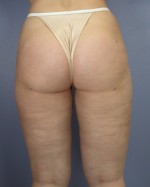 Liposuction Before and after photo
