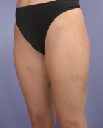 Liposuction Before and after photo