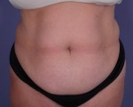 Liposuction