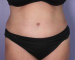 Liposuction