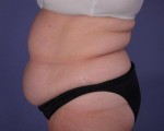 Liposuction