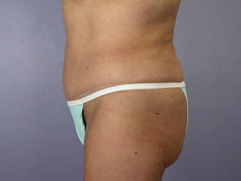 Liposuction before and after photo