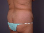 Liposuction Before and after photo