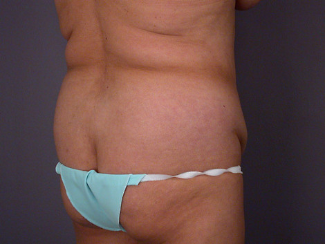 Liposuction before and after photo