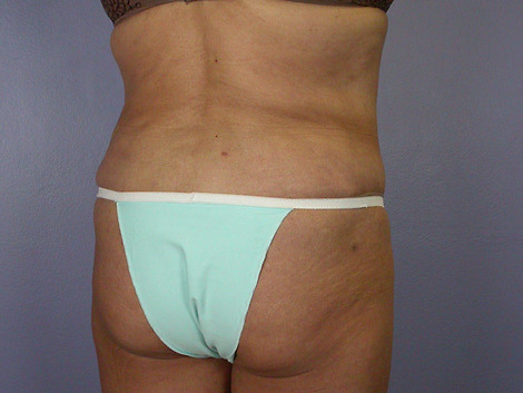 Liposuction before and after photo