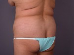 Liposuction Before and after photo