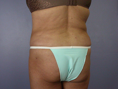 Liposuction before and after photo