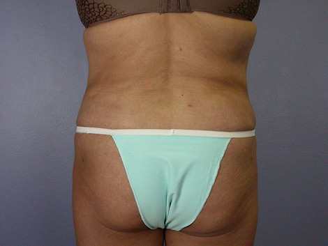 Liposuction before and after photo