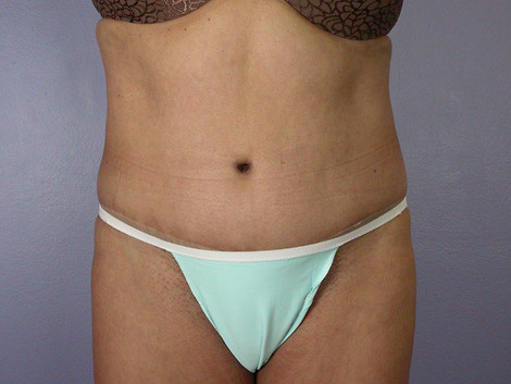 Liposuction before and after photo