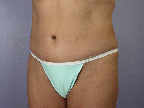 Liposuction before and after photo