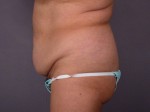 Liposuction Before and after photo