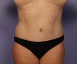 Liposuction