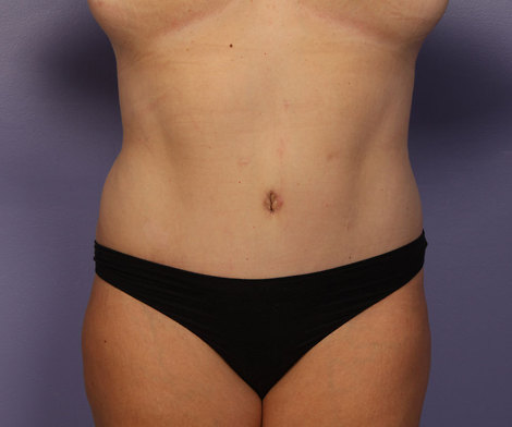 Liposuction before and after photo