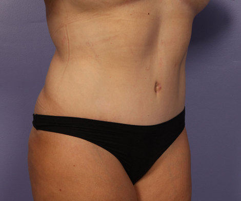 Liposuction before and after photo