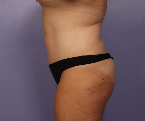 Liposuction before and after photo