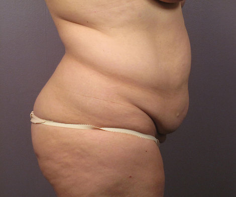 Liposuction before and after photo