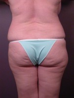 Liposuction Before and after photo