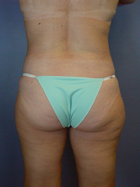 Liposuction before and after photo