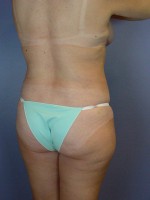 Liposuction Before and after photo