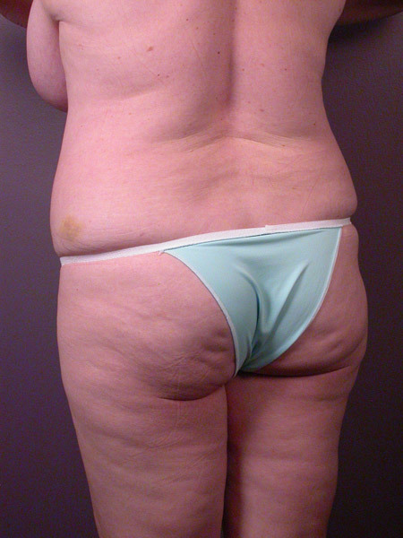 Liposuction before and after photo