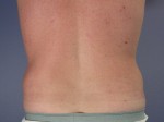 Liposuction Before and after photo