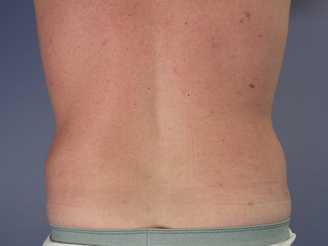 Liposuction before and after photo